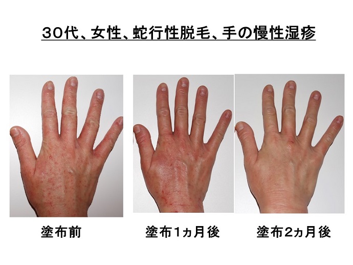 円形脱毛症　病院